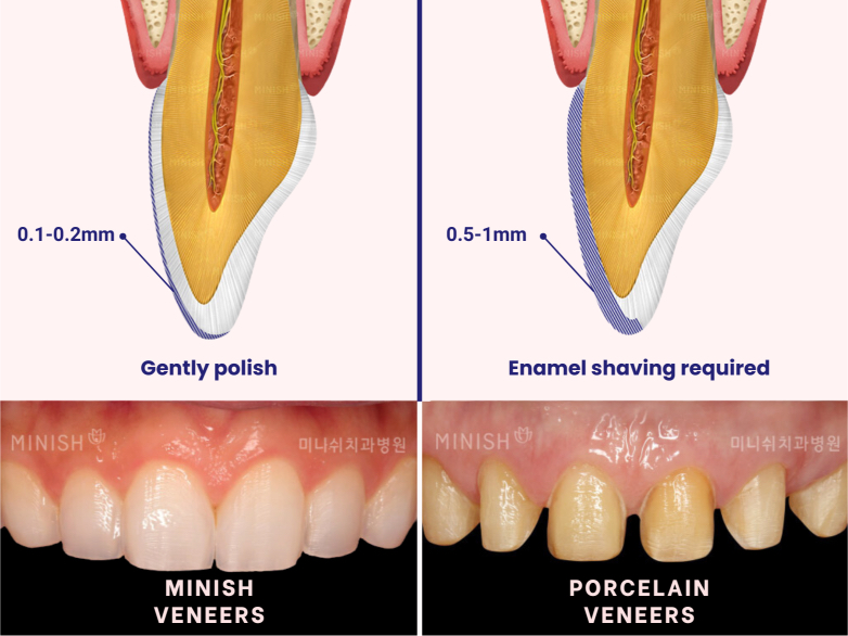 veneers south korea minish