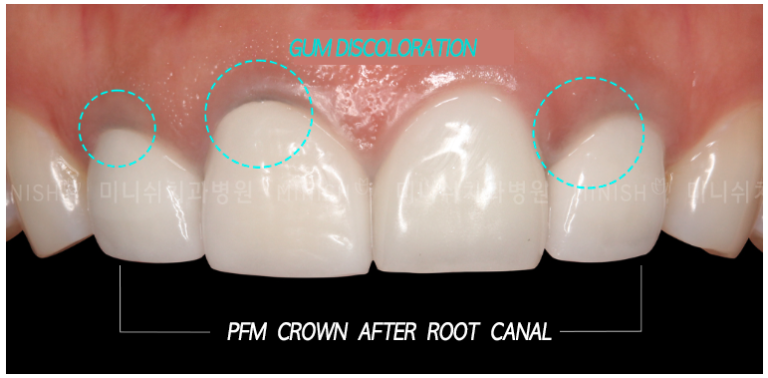 Solutions for Crown Retreatment